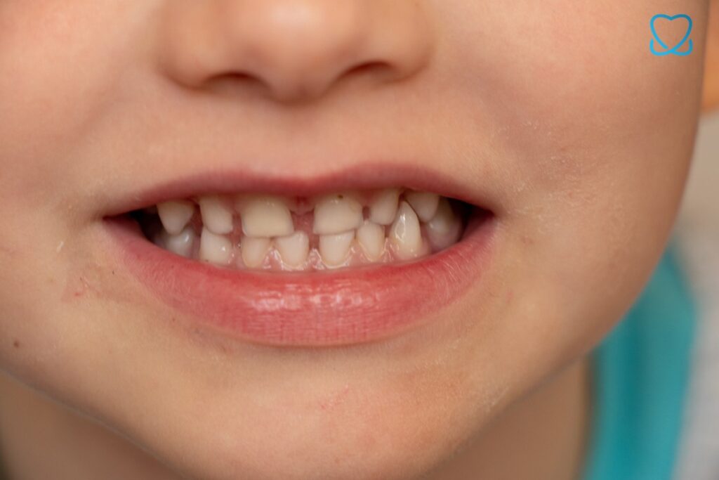 mleczne zęby - harmonogram wymiany