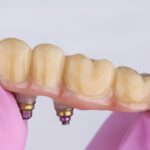 rany i otarcia dziąseł od protezy