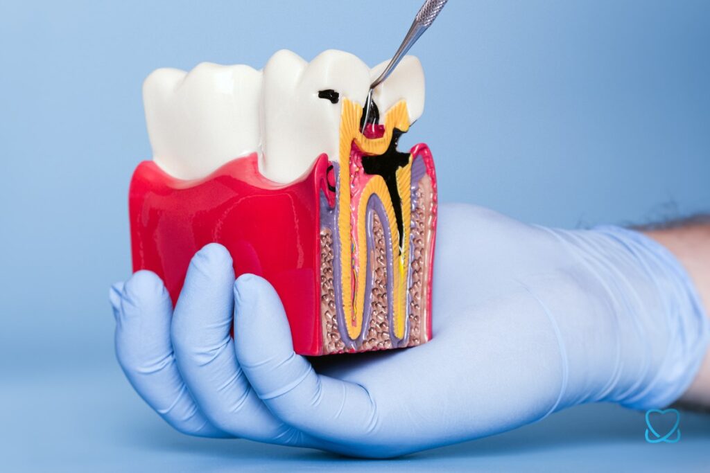 zgorzel zęba makieta